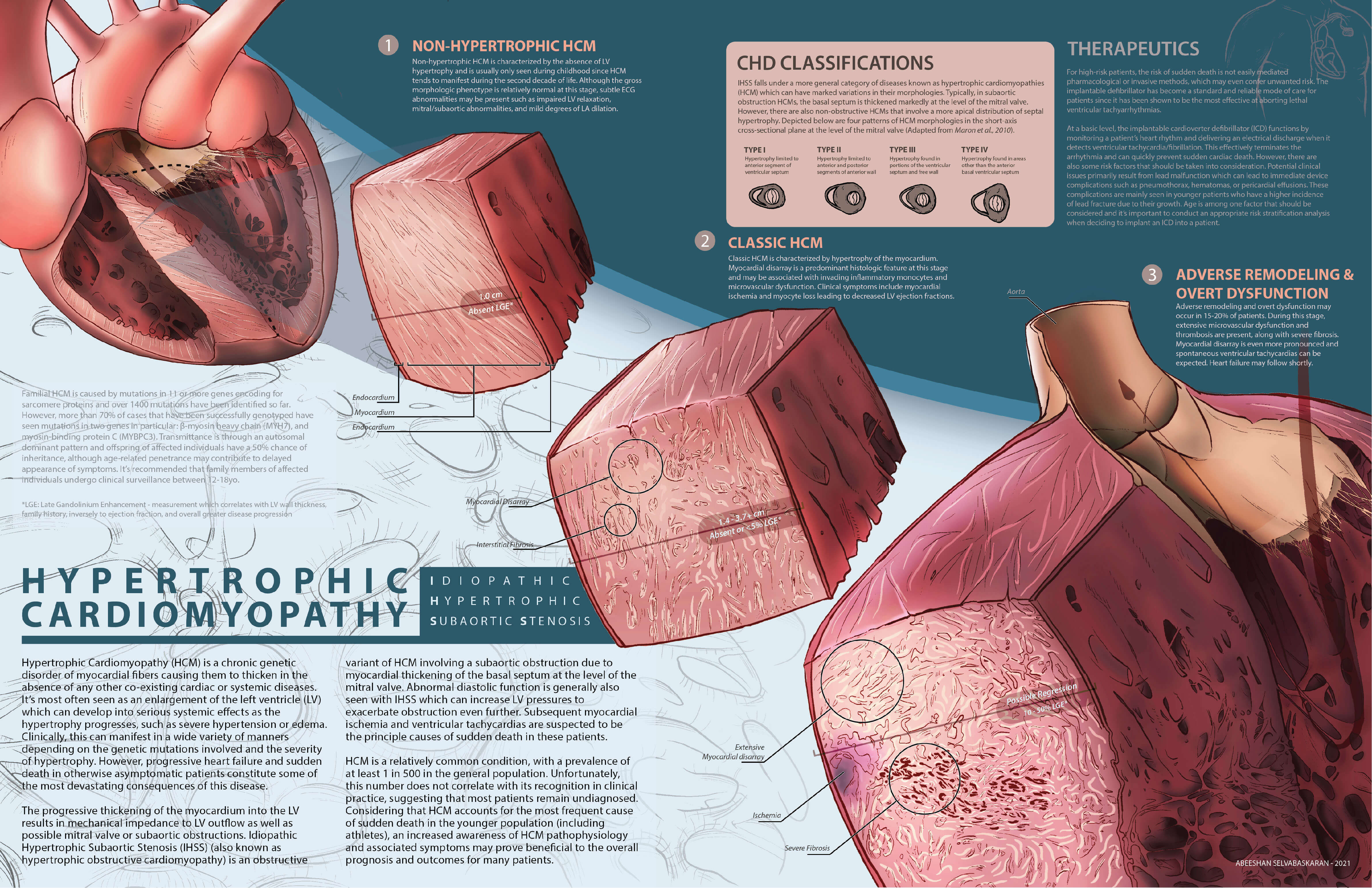 Final infographic on Hypertrophic Cardiomyopathy