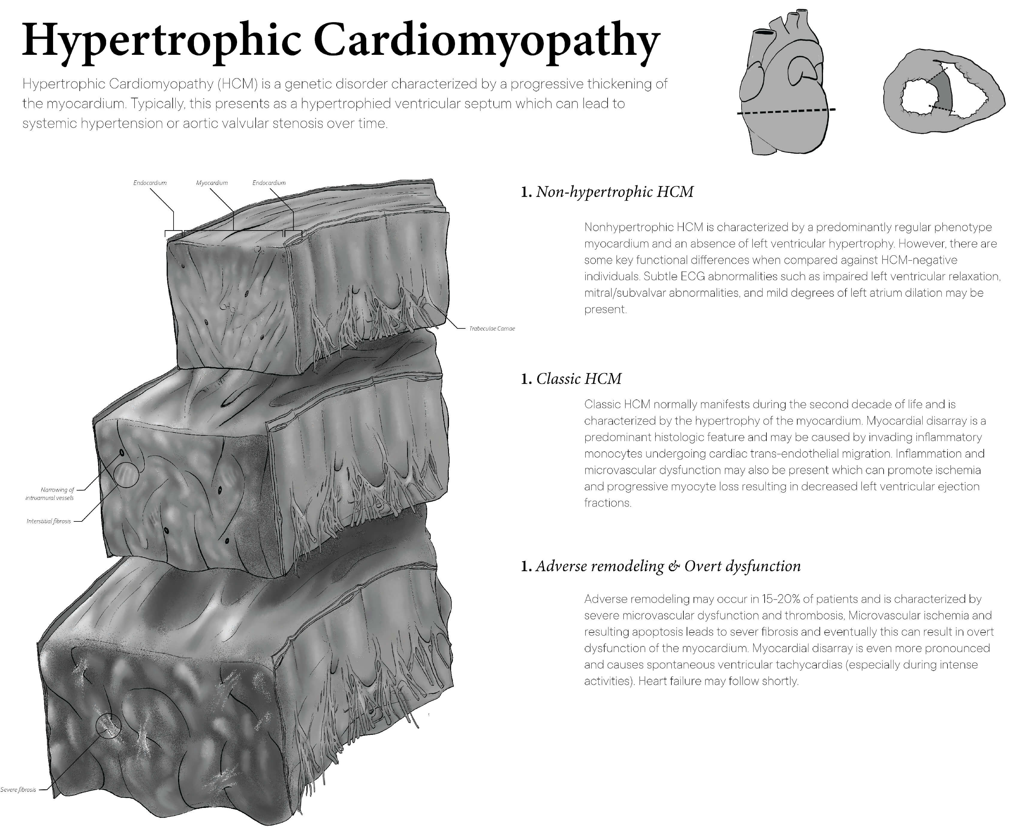 Tissue cube studies of ventricular septal wall in HCM