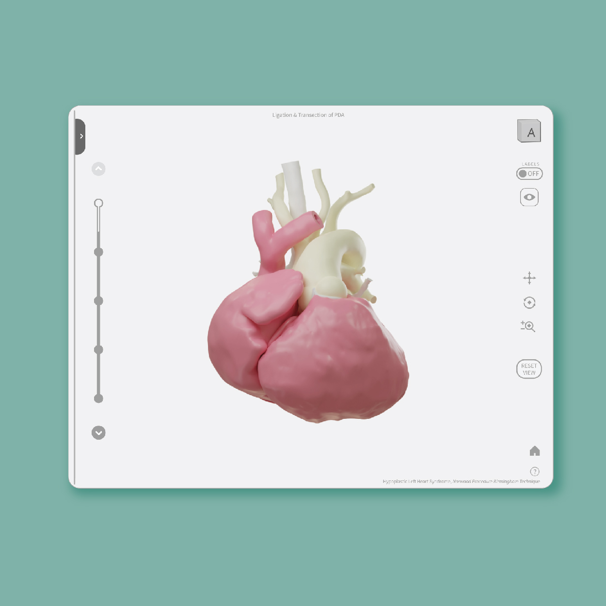 Thumbnail for 3D Print Heart Project - 3D rendered heart based on CT data