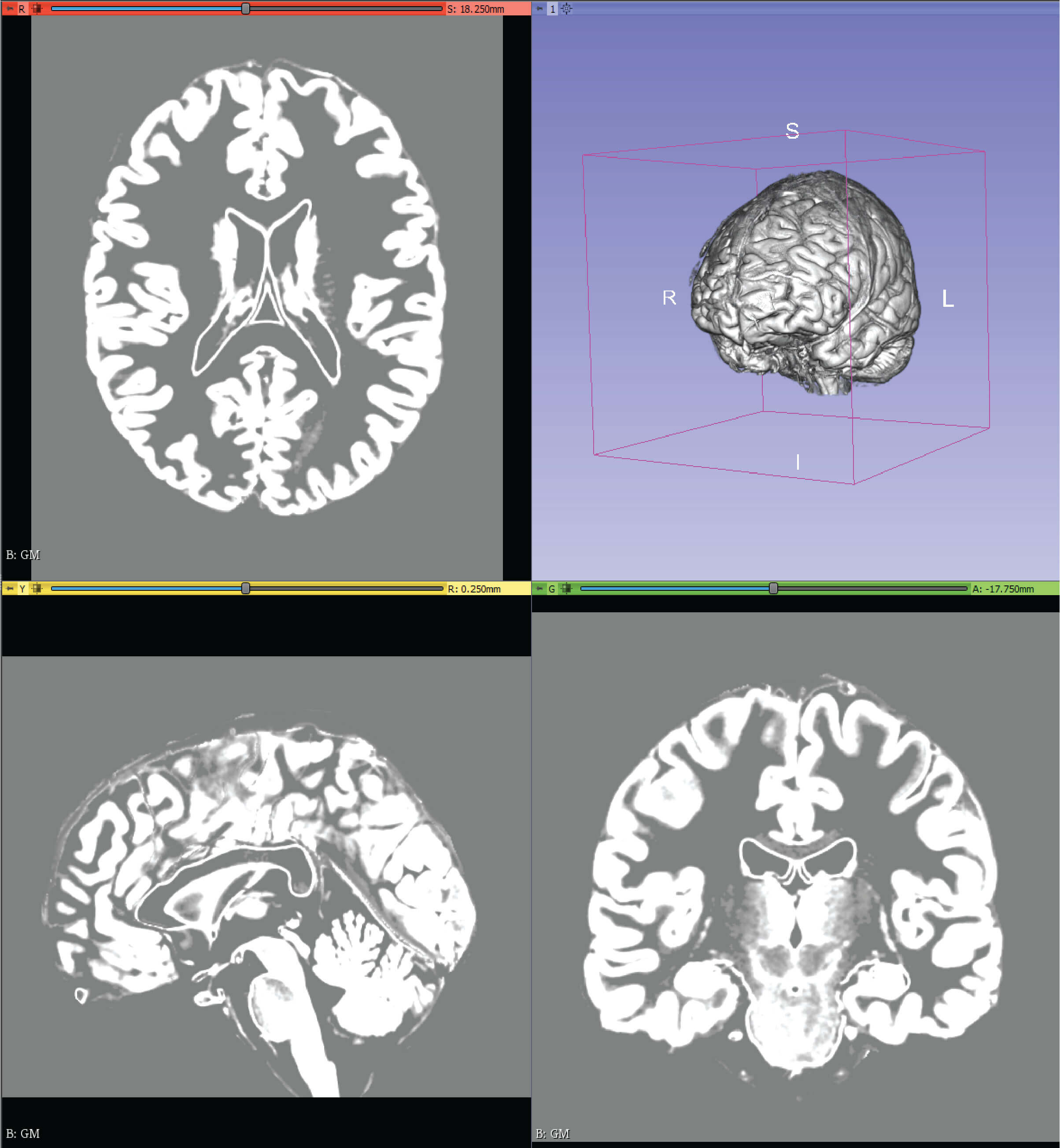 Screenshot from 3D slicer of Colin27 brain reference